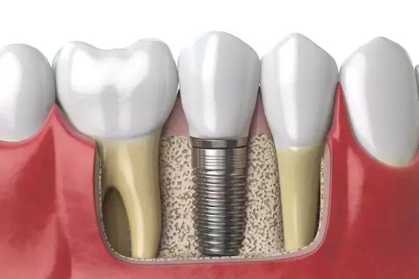 Implantologie und Zahnimplantate