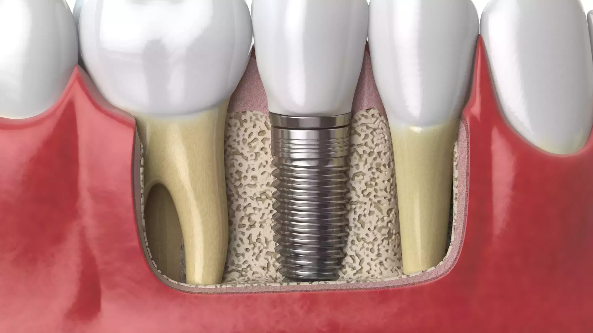 Implantologie und Zahnimplantate